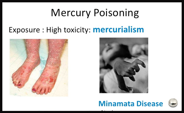 mercury poisoning is a debilitatind desease