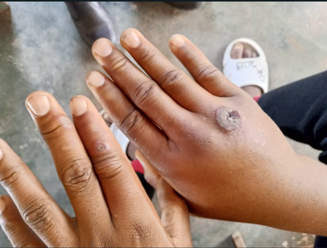 Govt reports suspected anthrax in Muchinga – Zambia: News Diggers!
