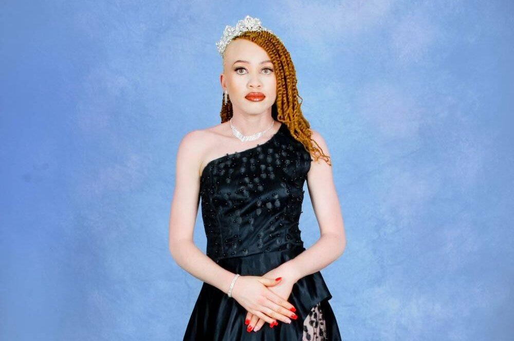 “There’s a myth that we taste differently sexually,” Suzy K opens up on challenges faced by women with albinism – Zambia: News Diggers!